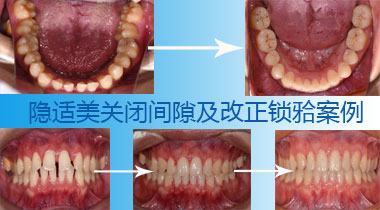 隐适关闭间隙