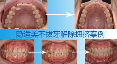 隐适美不拔牙解除拥挤