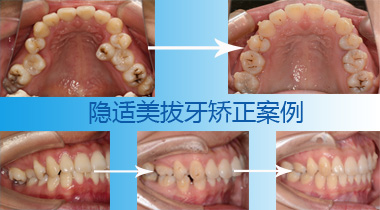 隐适美矫正