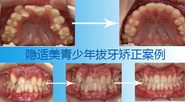 隐适美青少年矫正